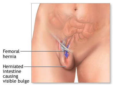 Thoát vị bẹn (Thoát vị háng) - Hình ảnh minh họa
