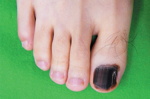 Tụ máu dưới móng - Hình ảnh minh họa