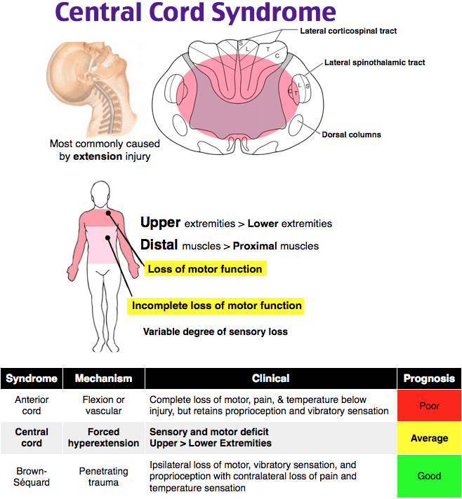 Central Cord Syndrome - Hình ảnh minh họa