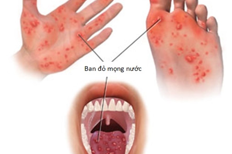 Tay - chân - miệng - Hình ảnh minh họa