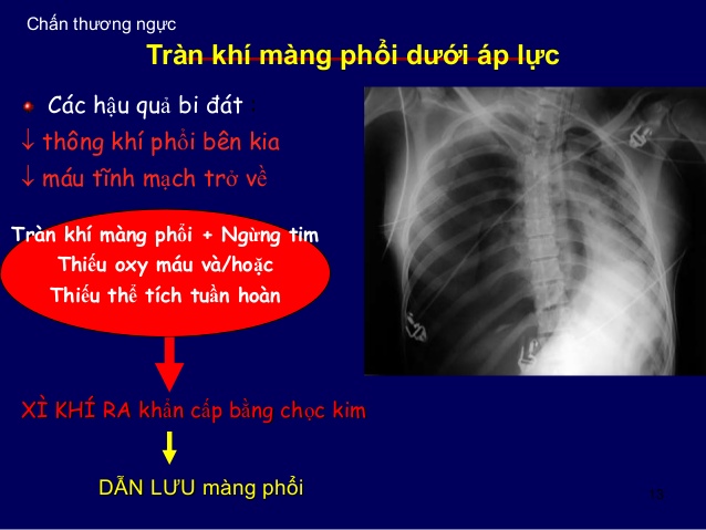 Tràn khí màng phổi áp lực - Hình ảnh minh họa