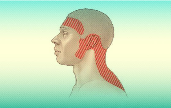 Tension headache - Hình ảnh minh họa