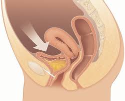 Urethritis - Hình ảnh minh họa