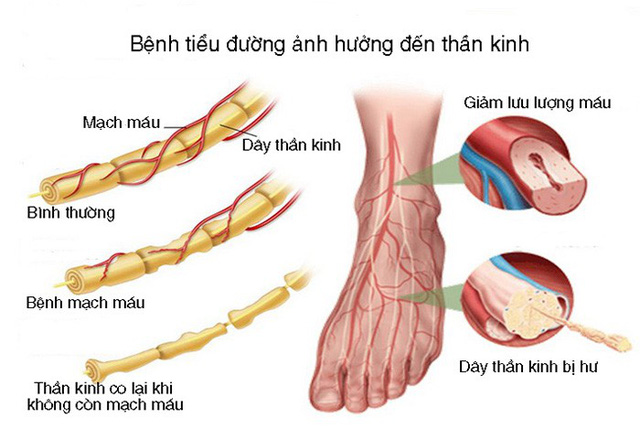 Thần kinh do đái tháo đường - Hình ảnh minh họa