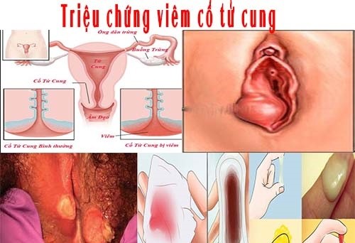 Viêm cổ tử cung - Hình ảnh minh họa