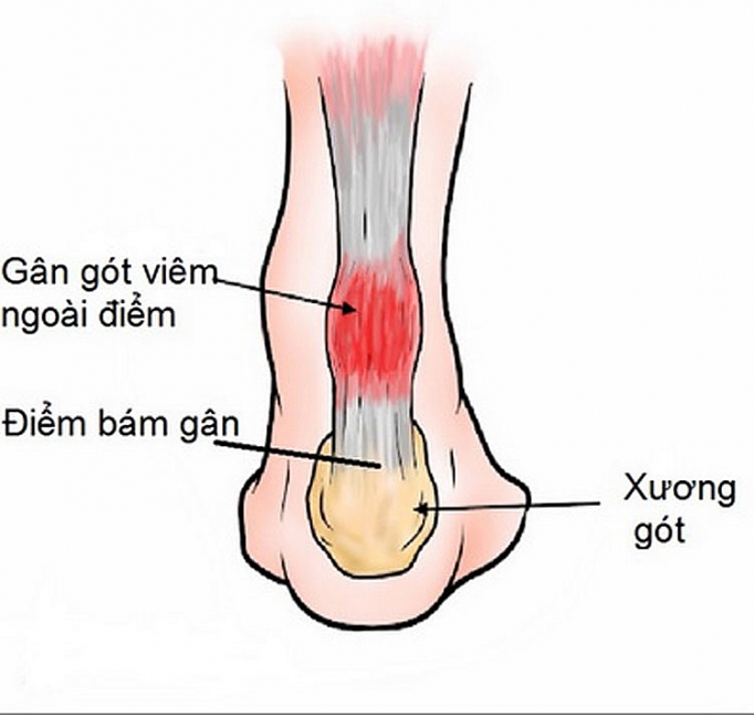 Viêm gân gót chân - Hình ảnh minh họa