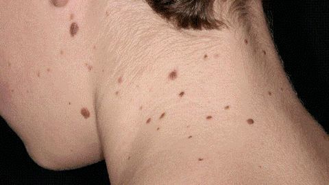 Ung thư da - Hình ảnh minh họa