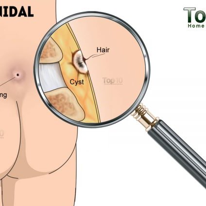 U nang Pilonidal (túi chất lỏng trên xương cụt) - Hình ảnh minh họa