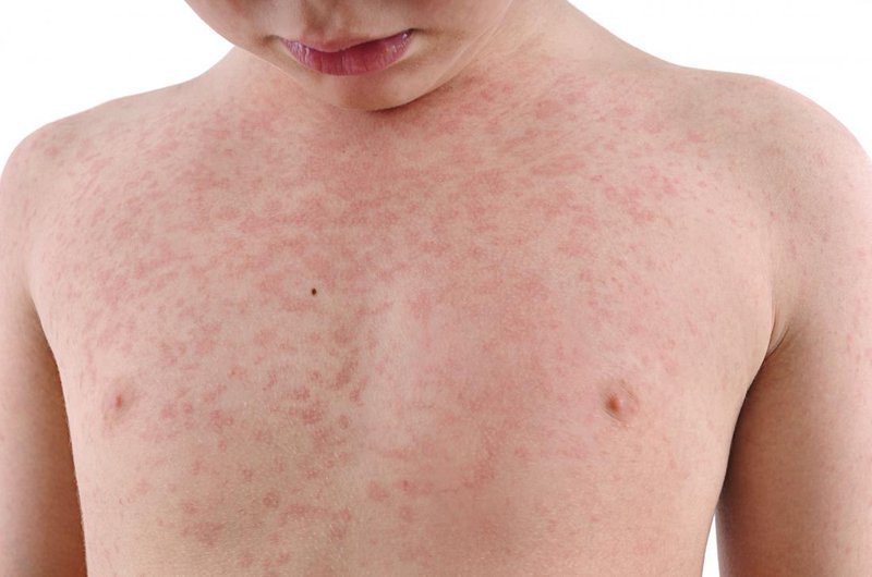 Rubella là bệnh gì? Nguyên nhân, triệu chứng, biến chứng và cách đề phòng - ảnh 1
