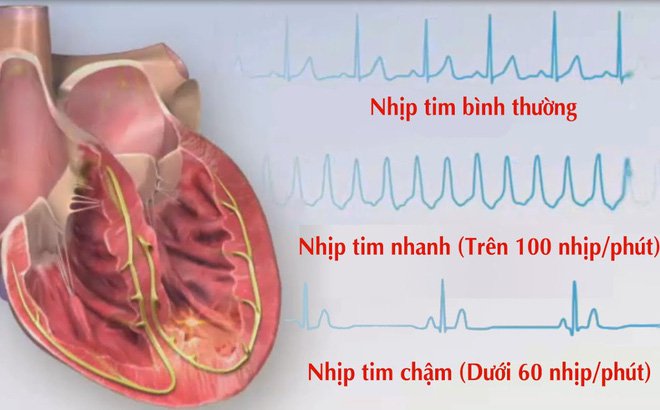 Nhịp tim bao nhiêu là bình thường? - ảnh 2