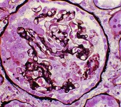 Viêm cầu thận mạn - Hình ảnh minh họa