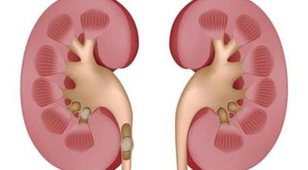 Viêm thận kẽ - Hình ảnh minh họa