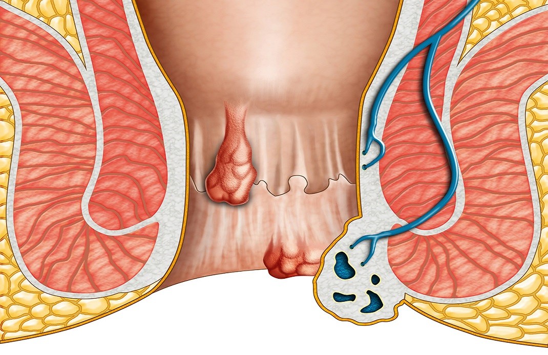 Ung thư ống hậu môn - Hình ảnh minh họa