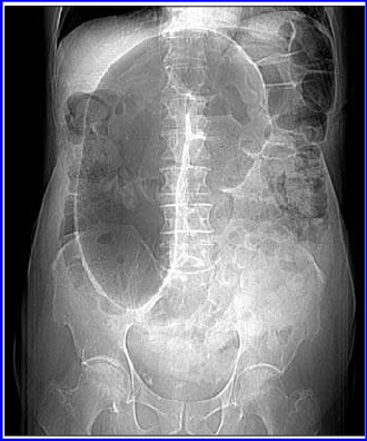 Volvulus - Hình ảnh minh họa