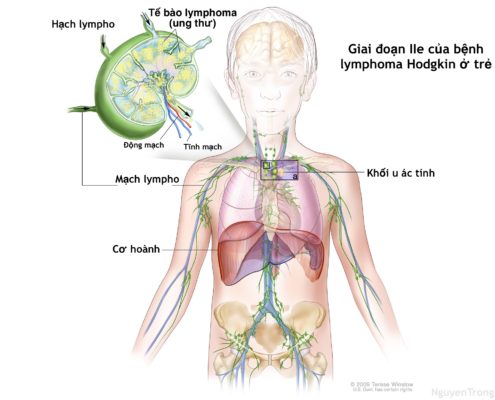 Ung thư Hodgkin - Hình ảnh minh họa