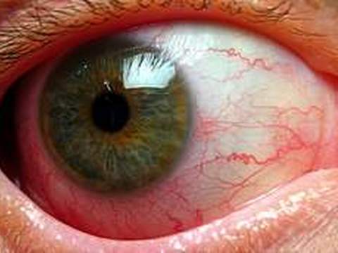 Uveitis - Hình ảnh minh họa