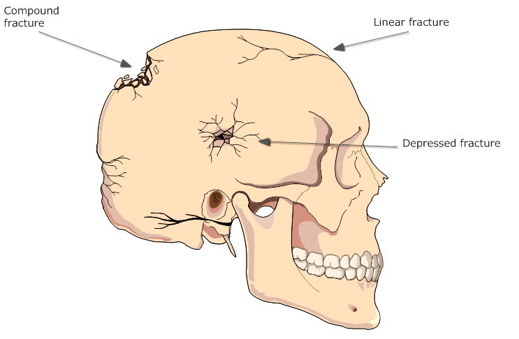 Vỡ xương sọ - Hình ảnh minh họa