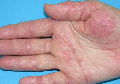 Viêm đa cơ - Hình ảnh minh họa