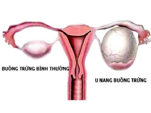 U nang buồng trứng xoắn - Hình ảnh minh họa