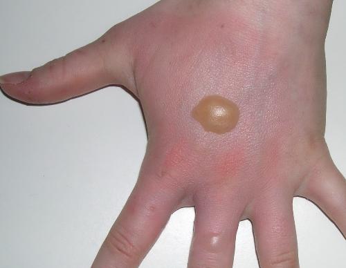 Vết thương thủng ở ngón chân - Hình ảnh minh họa