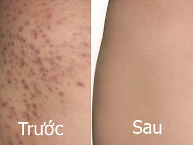 Viêm nang lông - Hình ảnh minh họa