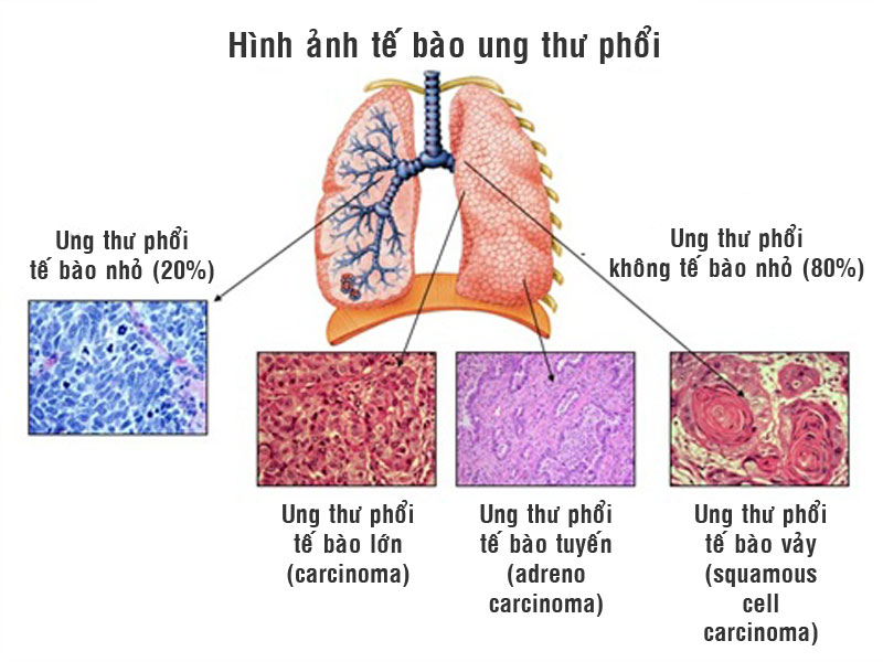 Ung thư phổi tế bào vảy - Hình ảnh minh họa