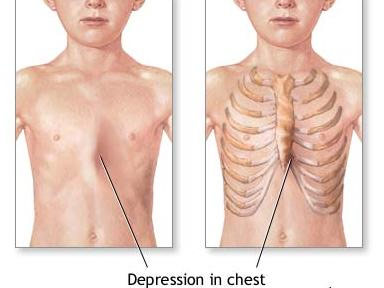 Viêm sụn sườn - Hình ảnh minh họa