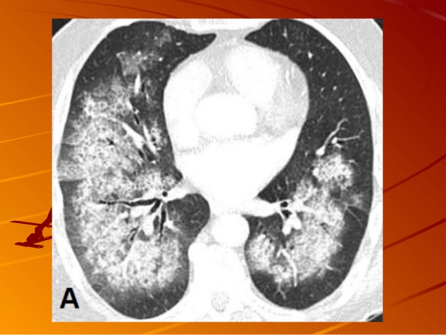U hạt Wegener - Hình ảnh minh họa