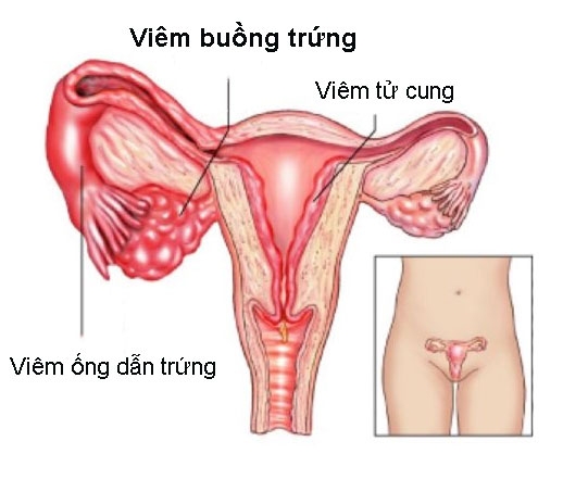 Viêm buồng trứng - Hình ảnh minh họa