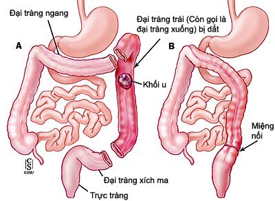 Viêm ruột do vi khuẩn Giardia - Hình ảnh minh họa