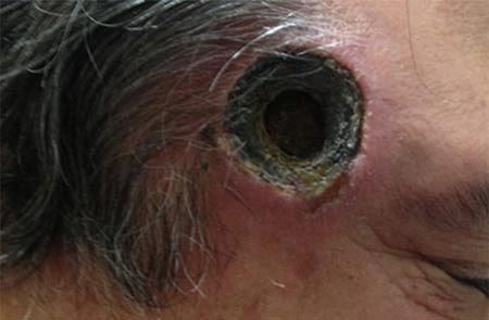 Vết thương thủng ở da đầu - Hình ảnh minh họa