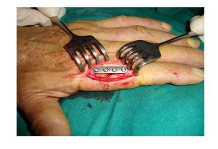 Vết rách ở cánh tay - Hình ảnh minh họa