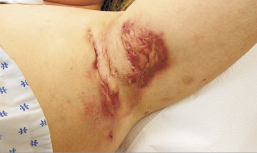 Viêm tuyến mồ hôi mưng mủ - Hình ảnh minh họa