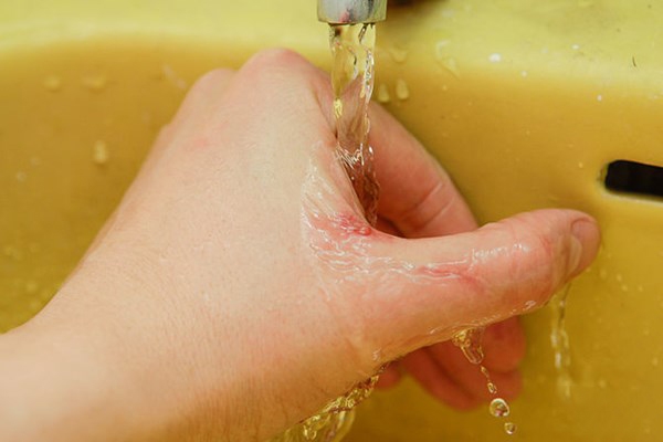 Vết thương thủng ở bàn tay - Hình ảnh minh họa