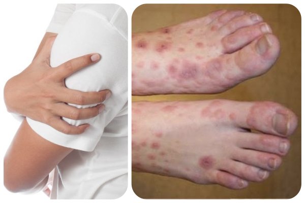 Wegener\'s Granulomatosis - Hình ảnh minh họa