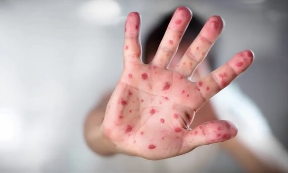 Vì sao phải tiêm 2 mũi vắc xin sởi? - ảnh 1