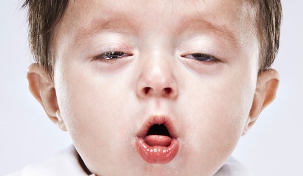 Whooping cough - Hình ảnh minh họa