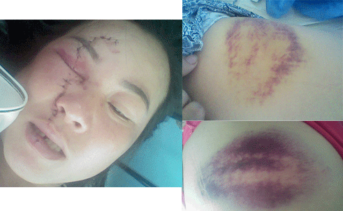 Vết rách trên mặt - Hình ảnh minh họa