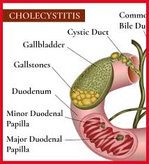 Cholecystitis - Hình ảnh minh họa