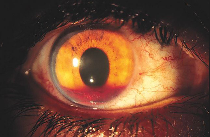 Xuất huyết tiền phòng - Hình ảnh minh họa