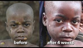 Yaws - Hình ảnh minh họa