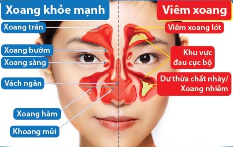 Viêm xoang mạn tính - Hình ảnh minh họa