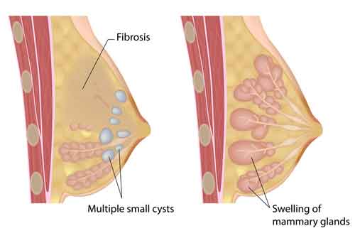 Xơ nang - Hình ảnh minh họa