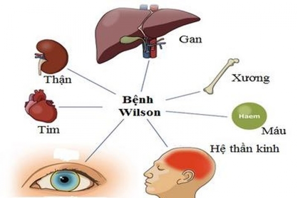 Wilson (rối loạn chuyển hoá Wilson) - Hình ảnh minh họa