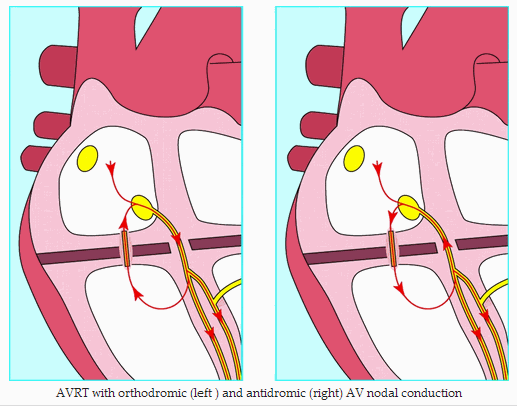 Wolff-Parkinson-White syndrome - Hình ảnh minh họa