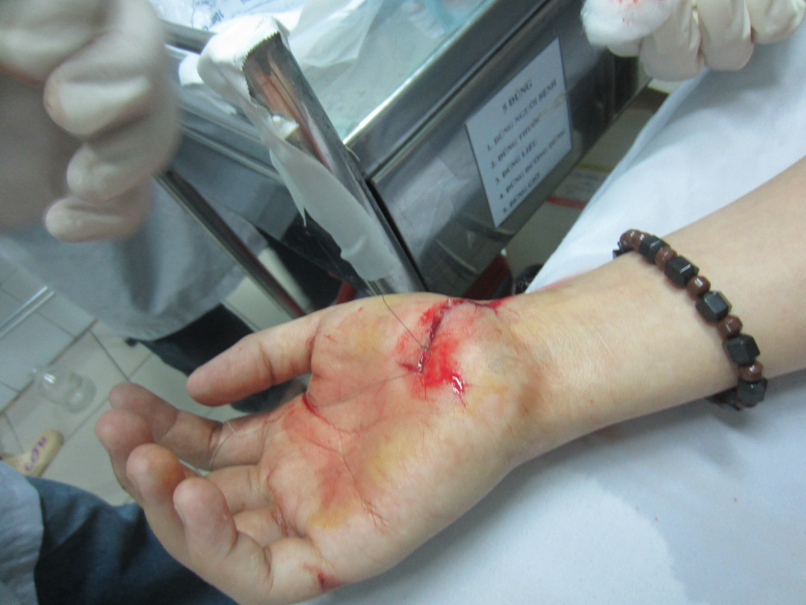 Vết thương thủng ở cánh tay - Hình ảnh minh họa