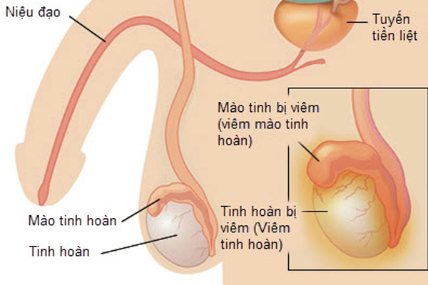 Viêm mào tinh hoàn - Hình ảnh minh họa