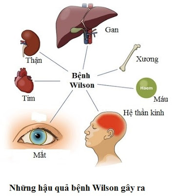 Wilson diseases - Hình ảnh minh họa