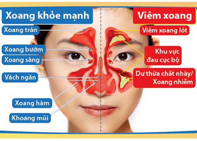 Viêm màng nhầy của mũi - Hình ảnh minh họa