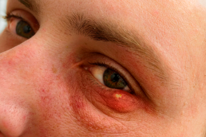 Viêm tế bào ổ mắt - Hình ảnh minh họa